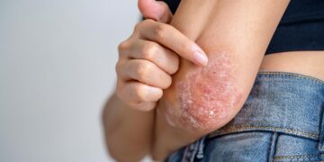 psoriasis