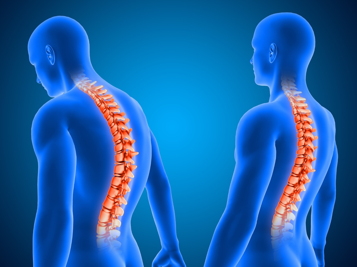 Spinal Muscular Atrophy